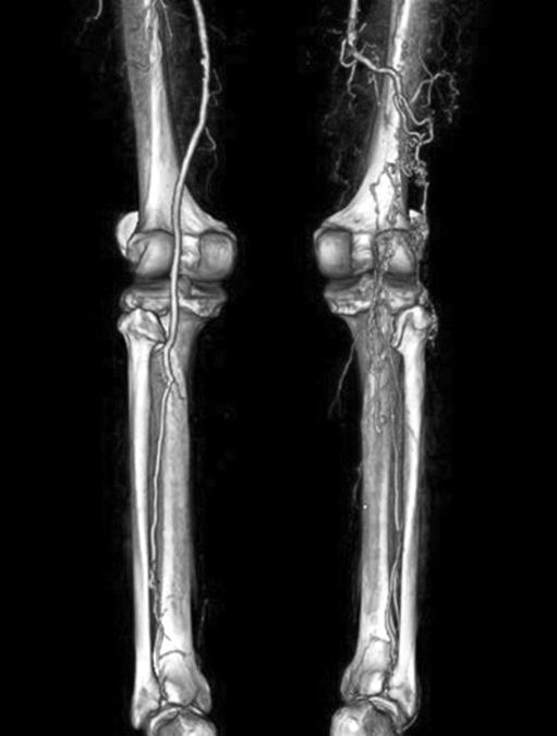 Young Sun Yoo, et al: Drug-eluting Stent in Below-the-knee CTO Lesion 81 한개발로슬와하부의동맥병변에대한경피적혈관성형술이계속보고되었다 (6,7). 그러나풍선만을사용한경우혈관의탄력반동에의한재협착으로성적이좋지않아이를보완하기위해혈관내스텐트삽입이시도되었다.