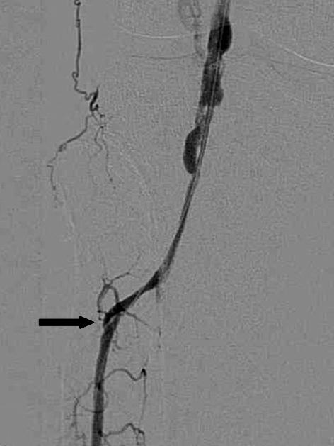 82 Korean J Vasc Endovasc Surg Vol. 27, No. 2, 2011 Fig. 2. After several times of balloon angioplasty, there was a flow-limiting dissection (arrow) on proximal anterior tibial artery (A).