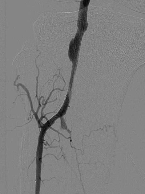 In CT arteriogram 16 months after implantation of stents, drug eluting stent in proximal anterior tibial artery keeps good patency. 잘유지하고있음을확인하였다 (Fig. 3). 환자는현재시술후 22개월째특별한문제없이외래에서경과관찰중이다.