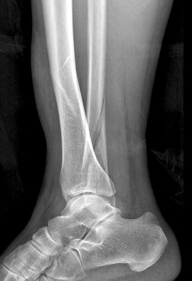 (D) Postoperative tibia AP and lateral image demonstrating articular congruency after screw fixation for a posterior malleolar fragment. Table 4.