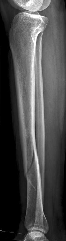 distal third of the tibia shaft.