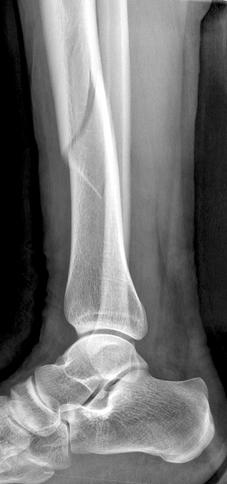 (C) Ankle axial computed tomography image showing a non-displaced posterior malleolar fracture.