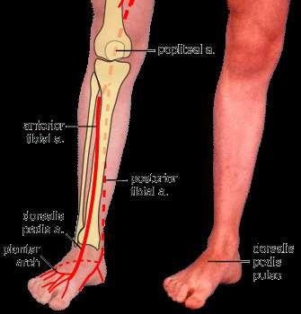 말초혈관질환 특징 주로무릎아래혈관침범