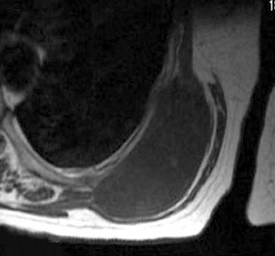 MR images demonstrate the well-circumscribed cystic masses located between the serratus anterior and the chest wall.