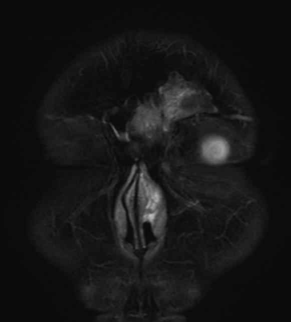 Korean J Otorhinolaryngol-Head Neck Surg 2018;61(9):478-84 밖에 다른 기저질환은 없었다 흡연 및 음주력은 없었으며 가족력에서도 특이사항은 없었다 비내시경 검사에서 좌측 중비도에