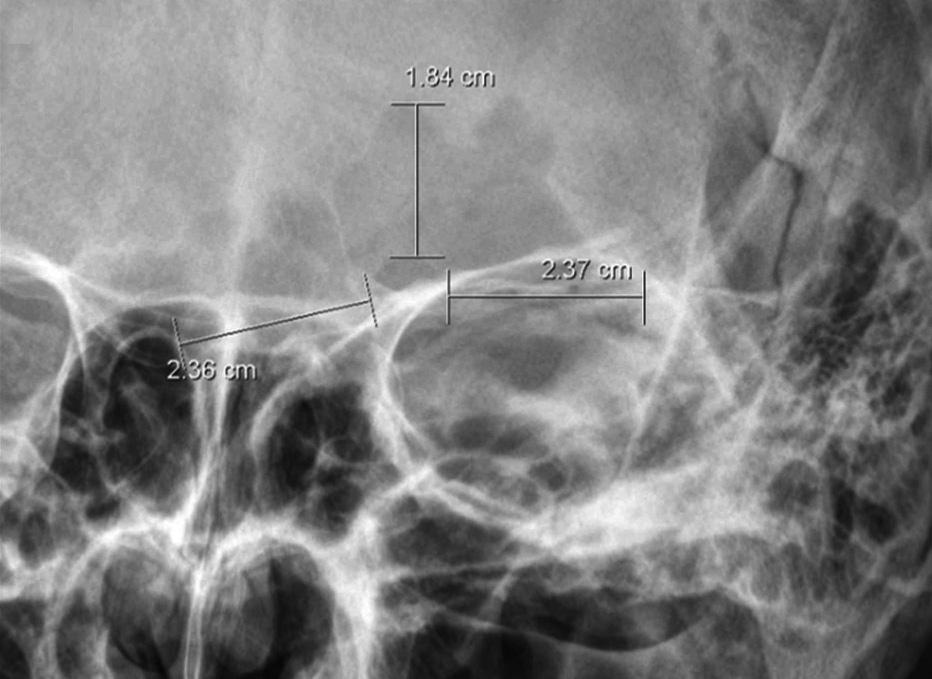 수술 전 촬영한 Caldwell 와 신경혈관 다발(supraorbital neurovascular bundle)의 손상 X-ray 영상에서 의료영상저장전송시스템(picture