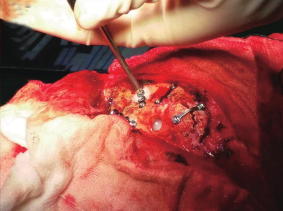 (C). Demonstration of multiple holes (blue arrowheads) on the dura mater after removal of the posterior
