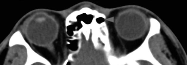 recurred of recurred tumor tumor are are visible visible within within the the left frontal left frontal sinus sinus (black (black arrows; arrows;,,, and and D), which D), which indicate