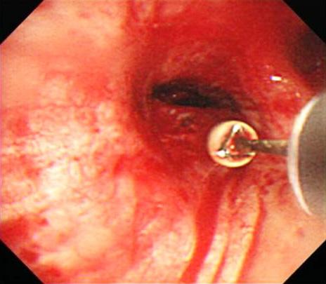 (B, C) Bronchoscopy shows the insulation-tipped diathermic knife-2 during the procedure and the recanalized