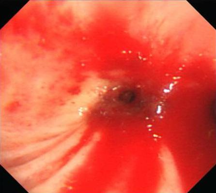 - 대한내과학회지 : 제 86 권제 6 호통권제 646 호 2014 - Figure 4. (A) Bronchoscopy shows near total obstruction with thickened mucosa and a small amount of bleeding at the right bronchus intermedius.