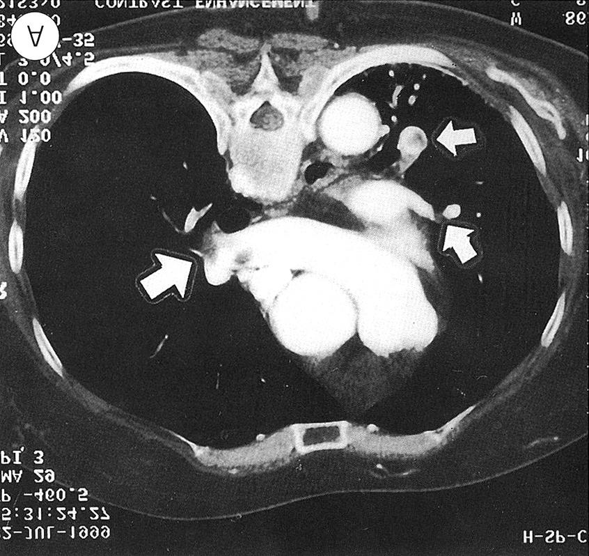 Fig. 2. Chest CT with angiography. A Hospital day 3rd (HD #3).