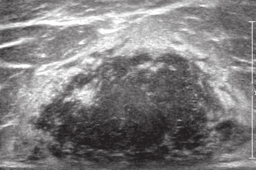 () Color Doppler image shows marked hypervascularity within the tumor. 10) 몰톤신경종 (Morton neuroma) 몰톤신경종은주로중년여성에서통증을동반한발가락사이종괴로나타난다.