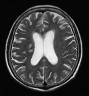 이지은김용방정혜영김지연손영민 A B C Figure 1. Magnetic resonance imaging of brain showed acute ischemic lesions in both basal ganglia (lenticulostriate arterial territories) with T2 hyperintensities.