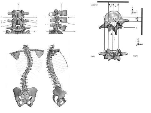 Coordinates from roentgenogram of King-Moe type II scoliosis Fig 2 B Conversion from normal 3-D FEM spine model to scoliosis model by