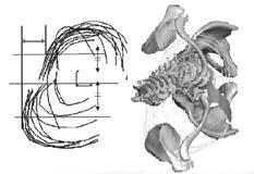 AVAR was defined as the rotation of the apex vertebra about its local z-axis Fig 4 Measurement of Rib Hump from 3-D FEM of scoliosis The rib hump was defined as a