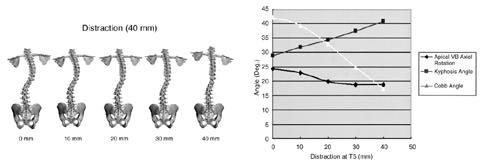 scoliosis The upper end vertebra (T5) was distracted 40 mm to cranial direction At each decadal point, 3-D FEM of scoliosis in coronal plane was displayed Fig 5 B