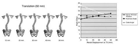 2, Cobb angle,,, 1 Cobb Angle,, Fig 6 A Translation of 3-D FEM of scoliosis The apex vertebra (T8) was translated 50 mm medially toward spinal column axis At each decadal point until 50 mm, 3-D FEM
