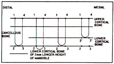 진지점에서상부치밀골, 하부치밀골, 해면골, 기저부에서각각측정하였다. 하중에의한하악골변위는악골높이차에의한변위차를고려하여같은악골높이에서측정이되도록측정점을설정했다.(Fig. 2) 발생된응력을바탕으로 microstrain 치를얻어악골내발생부하저오를예측하였다. Fig. 2. Reference points for deflection value(1;distal upper point, 2;distal lower point.