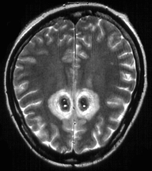 - A Figure 3. postoperative MRI findings of stereotactic anterior cingulotomy for intractable obsessive compulsive disorder.