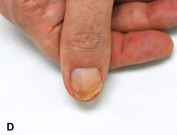 피부소견 : 오른쪽첫번째손톱의바닥에노란색의화농성병소가관찰되며그주위로손톱의이영양증이관찰되었다 (Fig. 3).