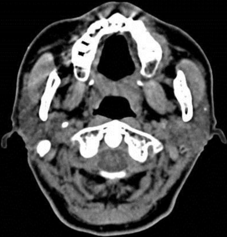 Korean J Otorhinolaryngol-Head Neck Surg 2015;58(8):567-71 Fig. 3. Axial view of neck CT scan 1 year after the first visit showed decreased number of the sialoliths in the parotid glands.