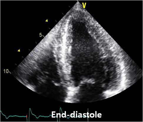Follow-up echocardiography revealed improvement of the dyskinetic motion of