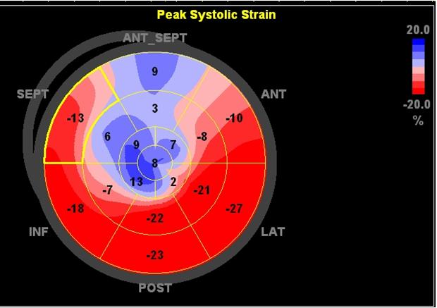 () Global longitudinal strain assessed by 2-dimensional strain