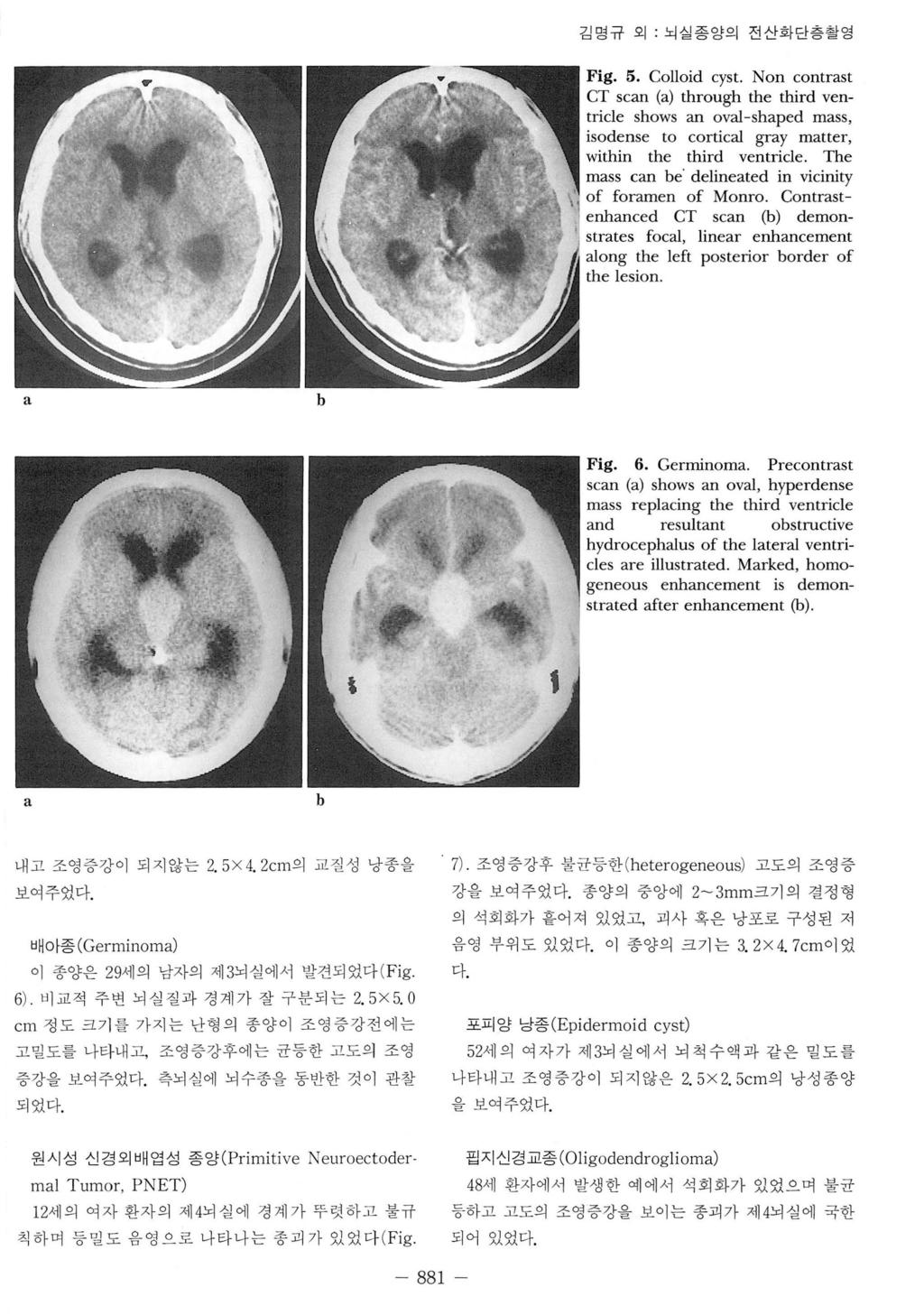 김명규 외 뇌실종앙의 전산화단층 촬영 Fig. 5. Colloid cyst. Non contrst CT scn () through the third ventricle shows n ovl-shped mss, isodense to corticl gry mtter, within the third ventricle.