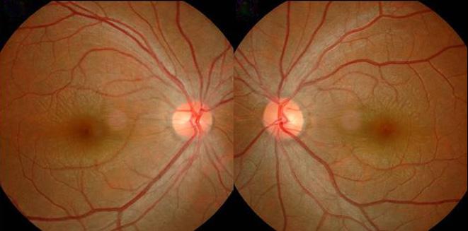 - 장선영외 : 불명열환자의근시성굴절력변화 - OD OS Figure 1. The fundus photograph shows retinal folds surrounding the macula. OD OS Figure 2. Ultrasound B-scan reveals choroidal thickening in both eyes.