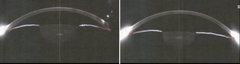 - 대한안과학회지 2009 년제 50 권제 8 호 - A Figure 3. Scheimpflug images of Pentacam (A: Day 3 B: Day 7) reveal the change of the anterior chamber depth. B 었다.
