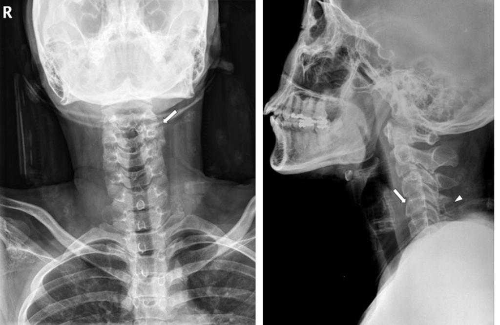initial visit. A B Fig. 2. Simple radiographs of the cervical spine.