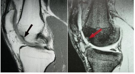 osteochondral lesions. Berndt & Harty for Fig.