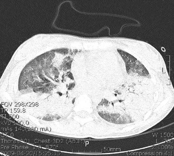 Tuberculosis and Respiratory Diseases Vol. 66. No. 6, Jun. 2009 Figure 2. Chest computed tomography imaging shows ground-glass opacity and consolidation in her both whole lung fields.