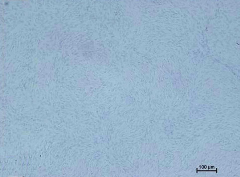 Histologic finding shows slender spindle cells arranging in storiform pattern (H&E stain 100) (A).