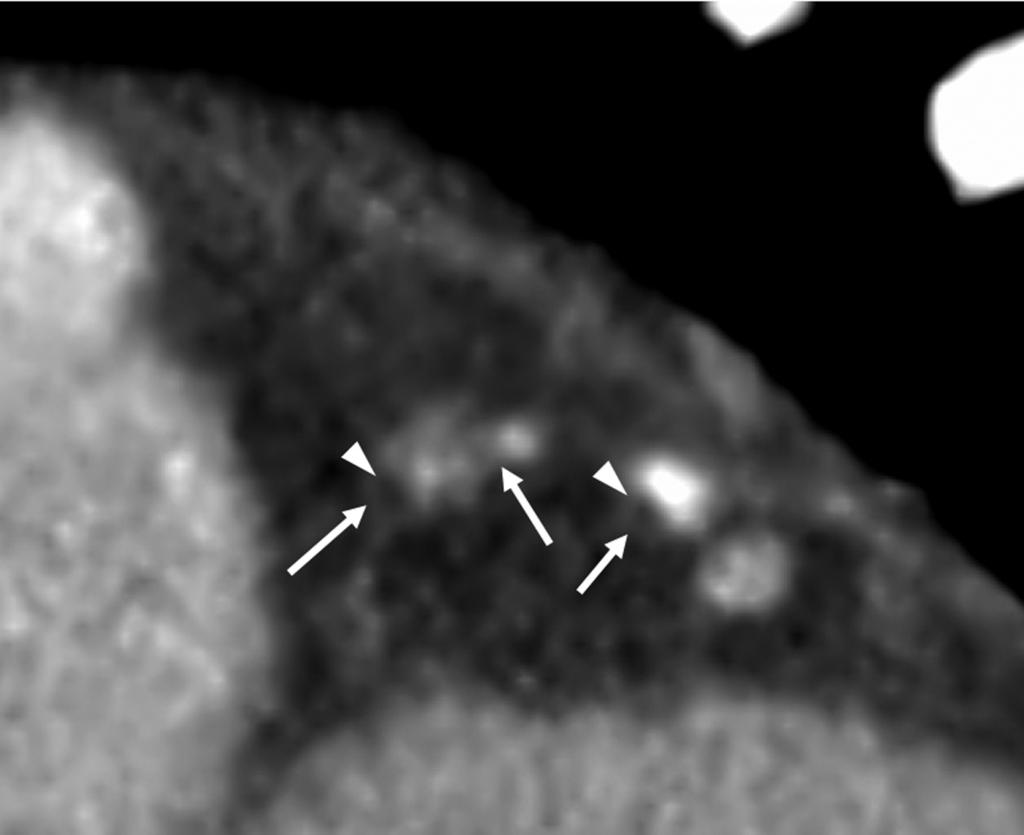 Volumerendered (A) and maximum intensity projection (B) images show stenosis