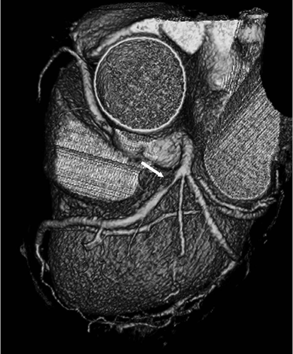 Atherosclerotic Plaques Evaluation Using MDCT Coronary