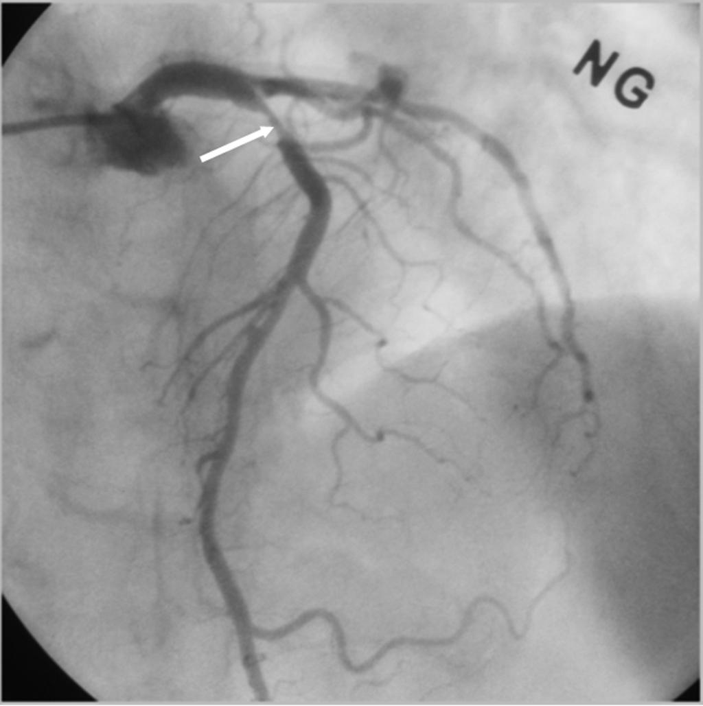 significant stenosis (arrow) with eccentric lumen and lipid