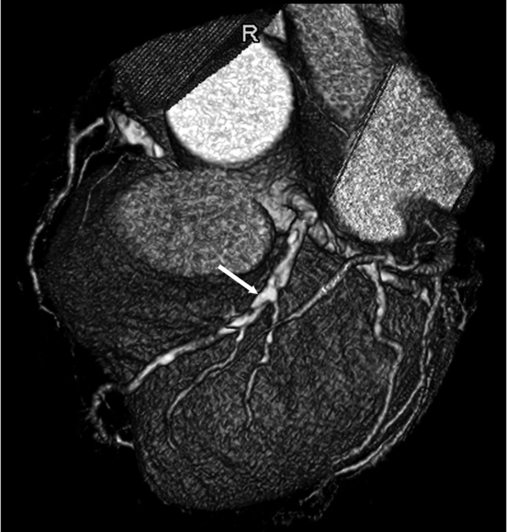 Atherosclerotic Plaques Evaluation Using MDCT Coronary Angiography A B C D Figure 6.