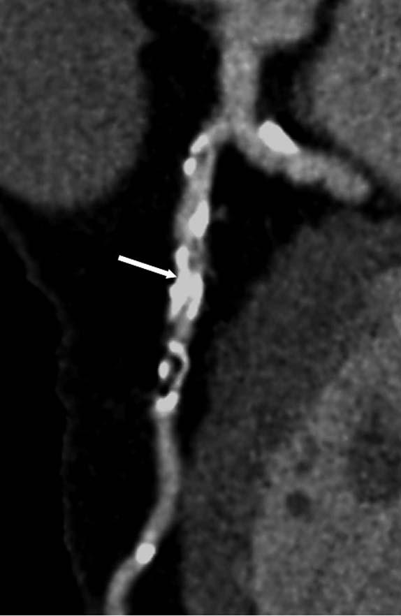 There are multiple calcifications in proximal to mid left anterior descending branch.