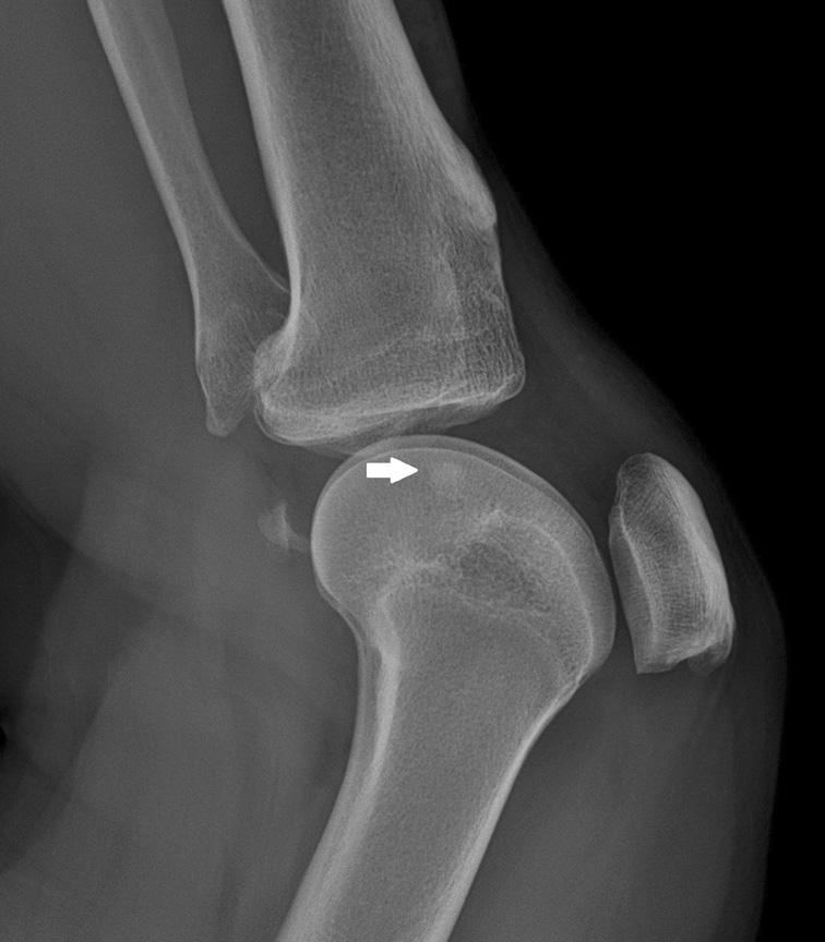 Plain anteroposterior () and lateral () radiographs of the left knee