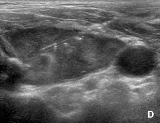 . On the transverse scan of thyroid ultrasonography, not only was the volume of the left lobe of the thyroid gland larger