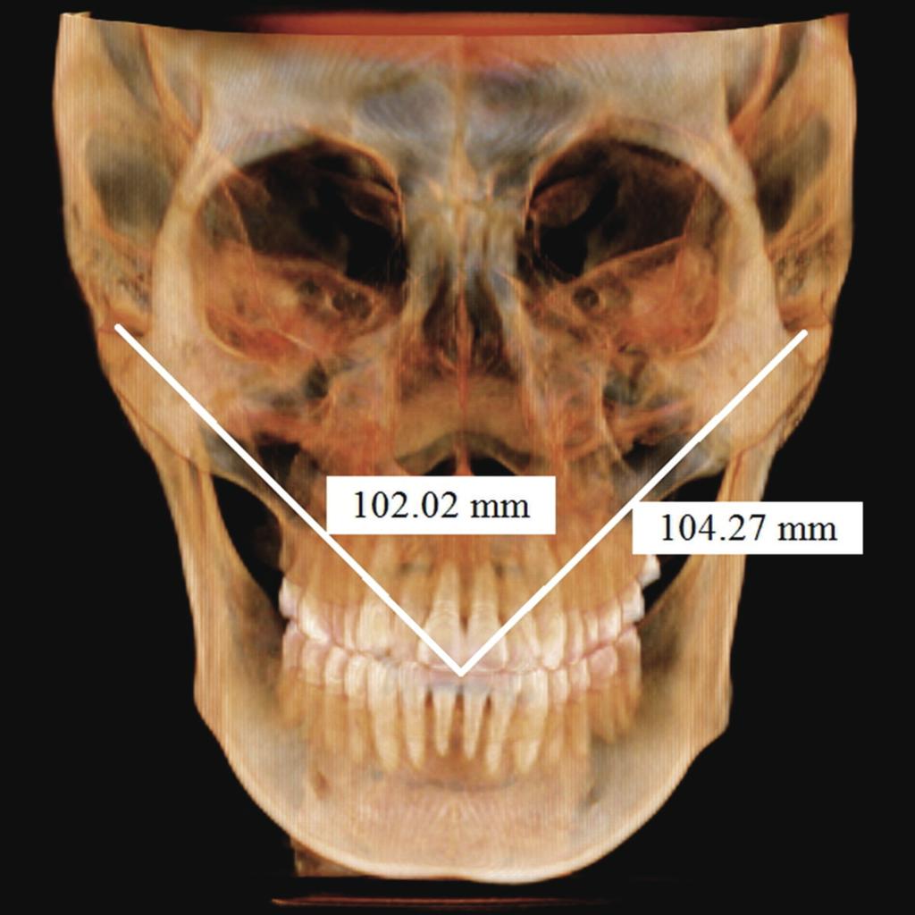 (A) Coronal viewm, (B) Sagittal view, (C) Axial view. A Fig. 4. Condyle-incisor distance.