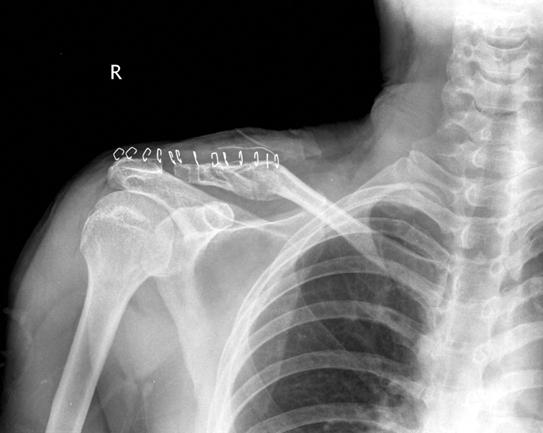 41 Hook 금속판을 이용한 원위 쇄골 골절 치료의 합병증 Fig. 1. Radiograhs of 52-year-old male. (A) Postoperative radiograph of the right shoulder shows Neer type II distal clavicle fracture.