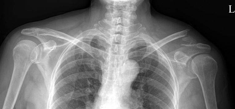 43 Hook 금속판을 이용한 원위 쇄골 골절 치료의 합병증 Fig. 4. Radiographs of 62-year-old female. (A) Preoperative radiograph of the left shoulder shows neer type II distal clavicle fracture. (B) Postoperative radiograph.