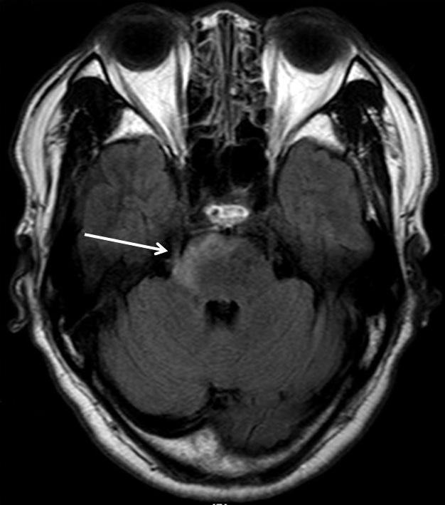 뇌간에서뇌신경을침범한신경매독 A B C D Fig. 1. A 63-year-old man with neurosyphilis involving the right trigeminal nerve. A. FLAIR axial image shows ill-defined high signal intensity at right pons and right middle cerebellar peduncle with extension to cisternal segment of right trigeminal nerve (arrow).
