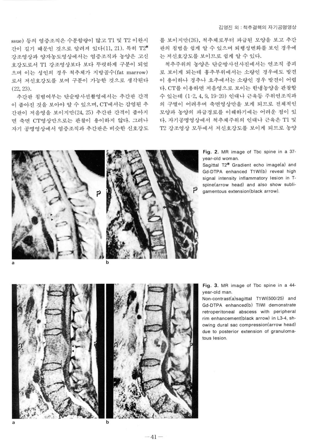 김영진외 척추결핵의자기공명영상 ssu e) 등의염증조직은수분함량이많고 T1 및 T 2 이완시간이길기때문인것으로알려져있다 (1 1, 21).
