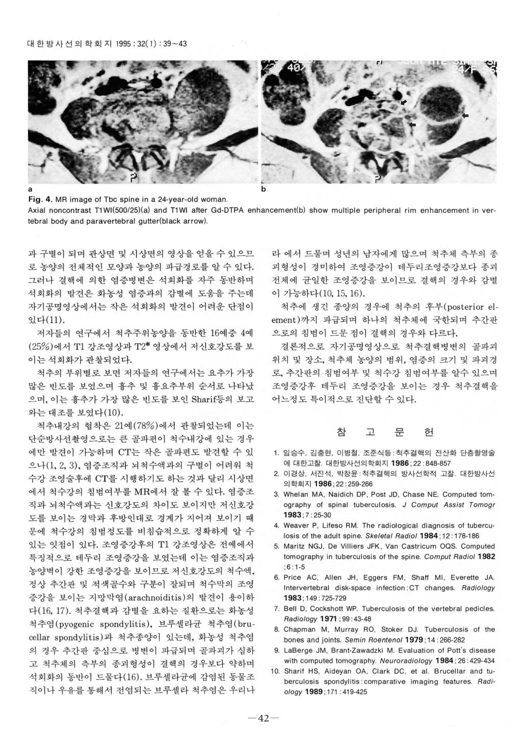 대한방사선의학회지 1995 ; 32( 1) : 39-43 Fig. 4.