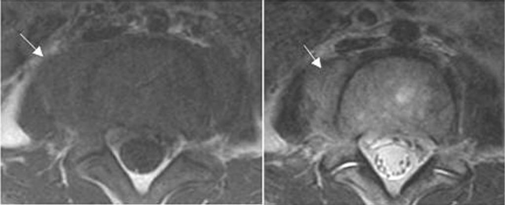 Axial T1- and T2-weighted images show ill-defined paraspinal infiltration of inflammation in right psoas muscle (arrow) at the level of L4.