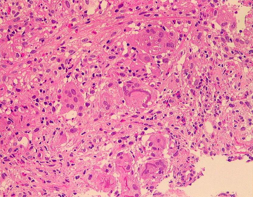 Prominent perivascular eosinophilic infiltration (B, H&E stain, 100) and granuloma