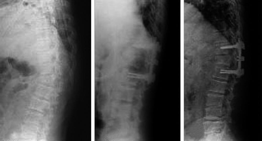 Transpedicular fixation including a fractured vertebra was done. KA and VWA was initial 7, 16 and immediate post-operation -22, 2, last follow-up -20, 2, After implant removal -19, 2.